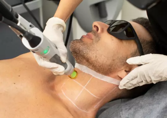 A man under going through a facial laser hair removal.